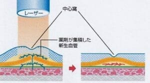 光線力学的療法