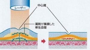 光凝固術