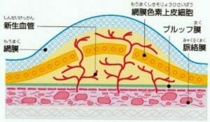 黄斑の病気