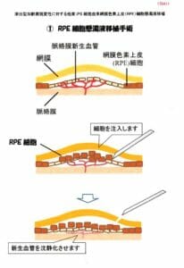 RPE 細胞懸濁液移植手術　図解