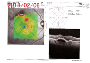 OCT（光干渉断層計）検査２